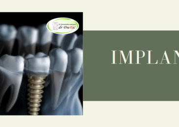 Implantati su najbolje rješenje za nadoknadu izgubljenog zuba